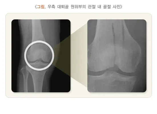 무릎 관절 주위의 골절 치료 설명 이미지 1