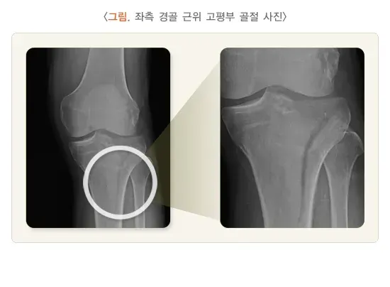 무릎 관절 주위의 골절 치료 설명 이미지 3