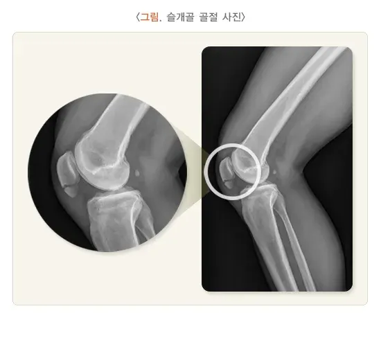 무릎 관절 주위의 골절 치료 설명 이미지 2