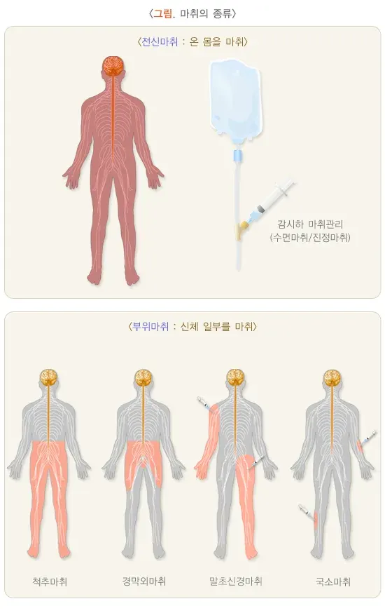 전신마취 치료의 적응증 설명 이미지 1