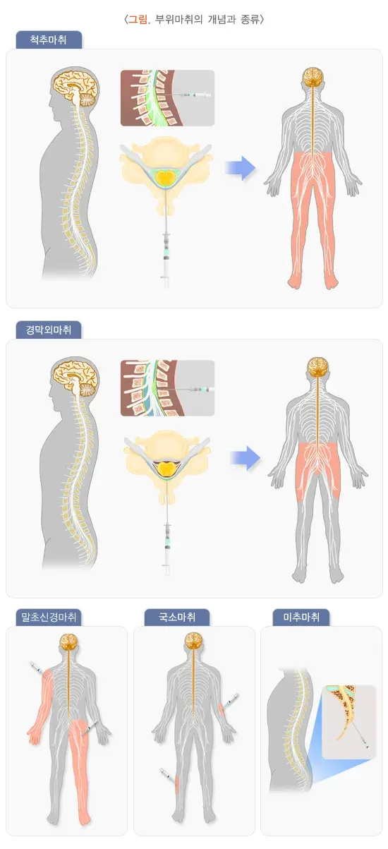 부위마취 치료의 적응증 설명 이미지 1