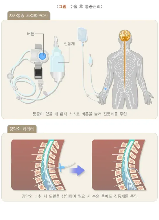 전신마취 치료 관련 주의사항 설명 이미지 1
