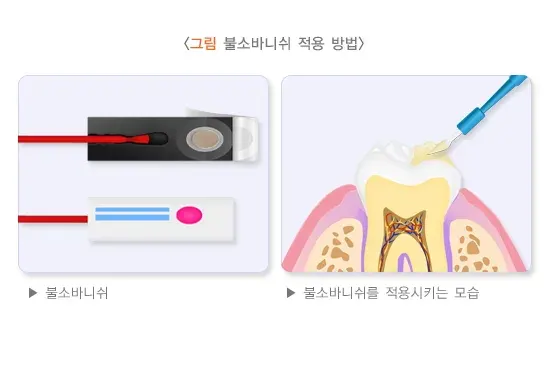 불소도포 일반적 실천 방법 설명 이미지 2