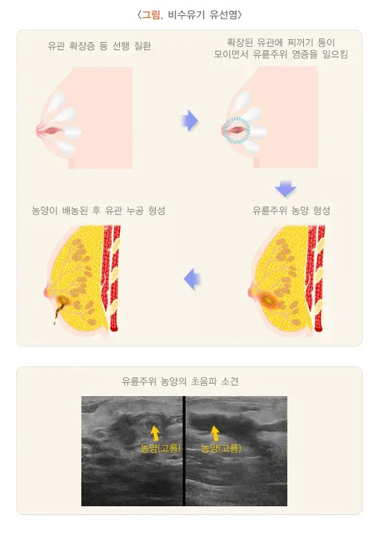 유선염 종류 설명 이미지 1
