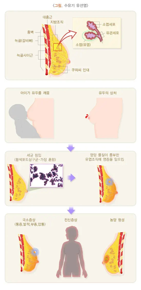 유선염 종류 설명 이미지 2