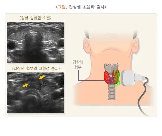 경부 종괴 진단 및 검사 설명 이미지 1