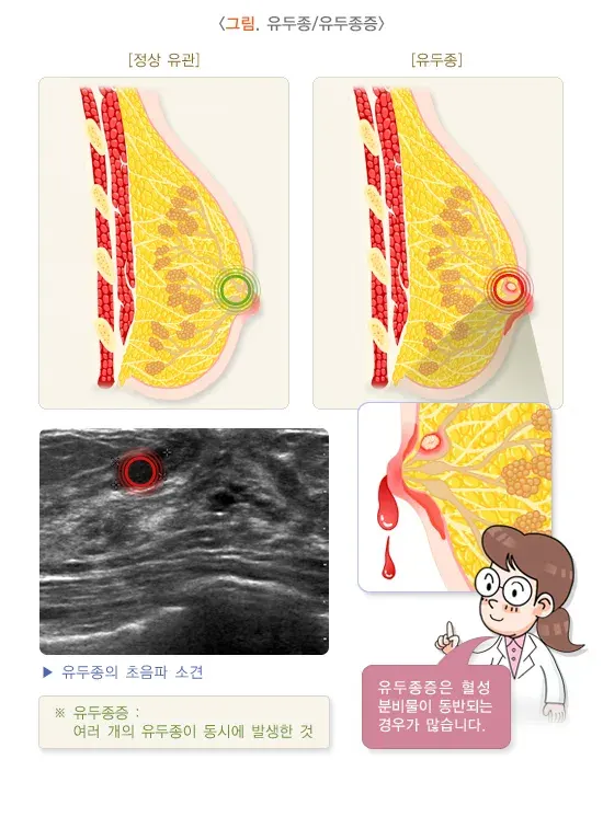 유방종괴 원인 설명 이미지 3