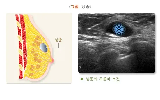 유방종괴 원인 설명 이미지 1