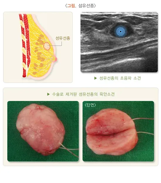 유방종괴 원인 설명 이미지 2