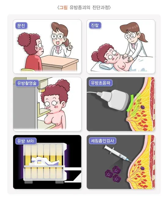 유방종괴 진단 및 검사 설명 이미지 1