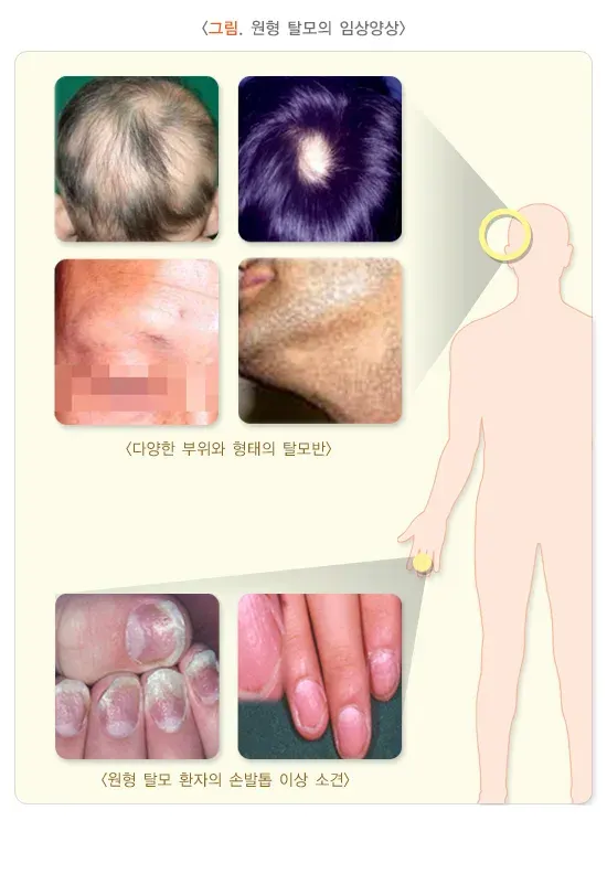 원형탈모 증상 설명 이미지 1