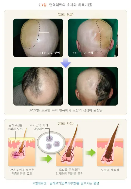 원형탈모 치료 설명 이미지 1
