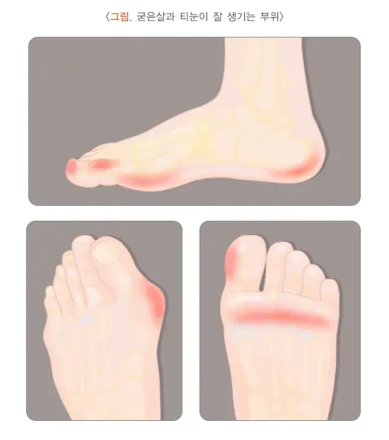 굳은살과 티눈 원인 설명 이미지 1