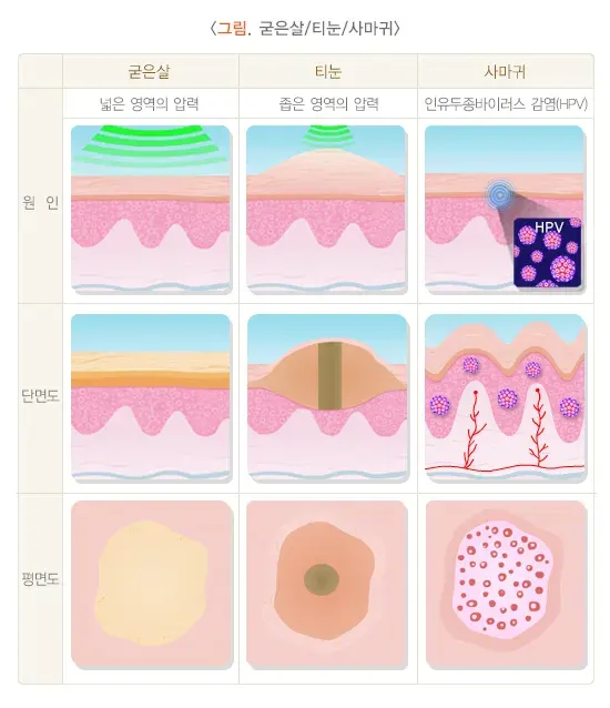 굳은살과 티눈 진단 및 검사 설명 이미지 1
