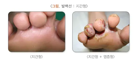 발 백선(무좀) 증상 설명 이미지 1