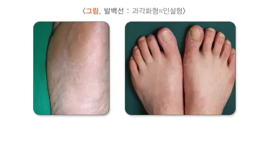 발 백선(무좀) 증상 설명 이미지 3