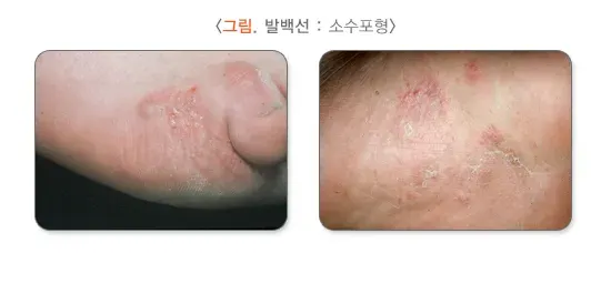 발 백선(무좀) 증상 설명 이미지 2