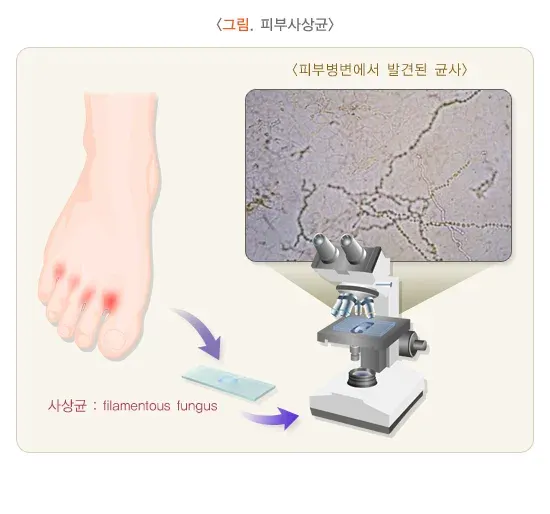 발 백선(무좀) 진단 및 검사 설명 이미지 1