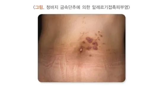 습진 종류 설명 이미지 2