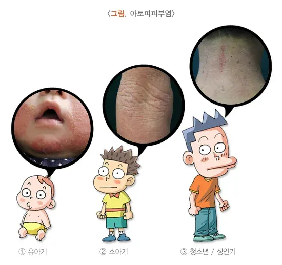 습진 종류 설명 이미지 3