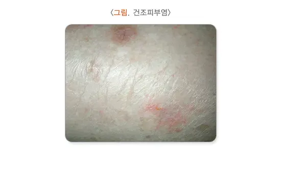 습진 종류 설명 이미지 6