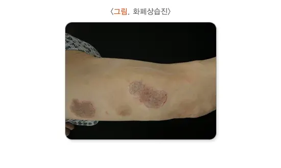 습진 종류 설명 이미지 5