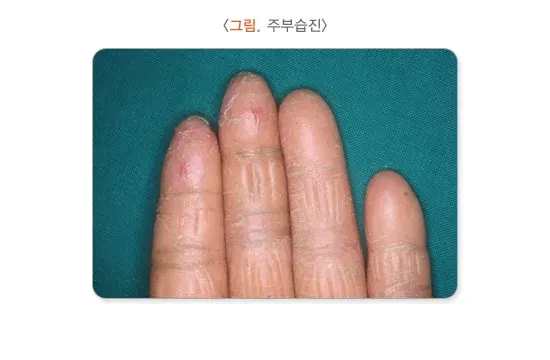 습진 종류 설명 이미지 1
