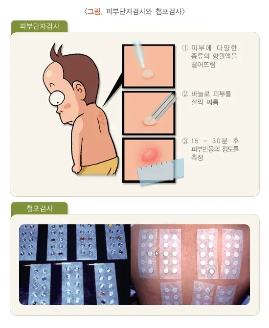 습진 진단 및 검사 설명 이미지 1