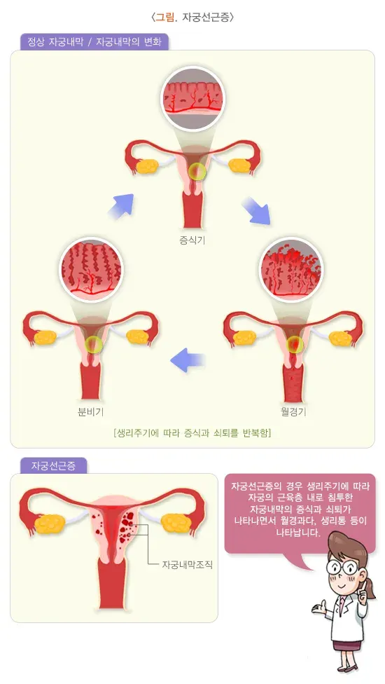 생리통 진단 및 검사 설명 이미지 1