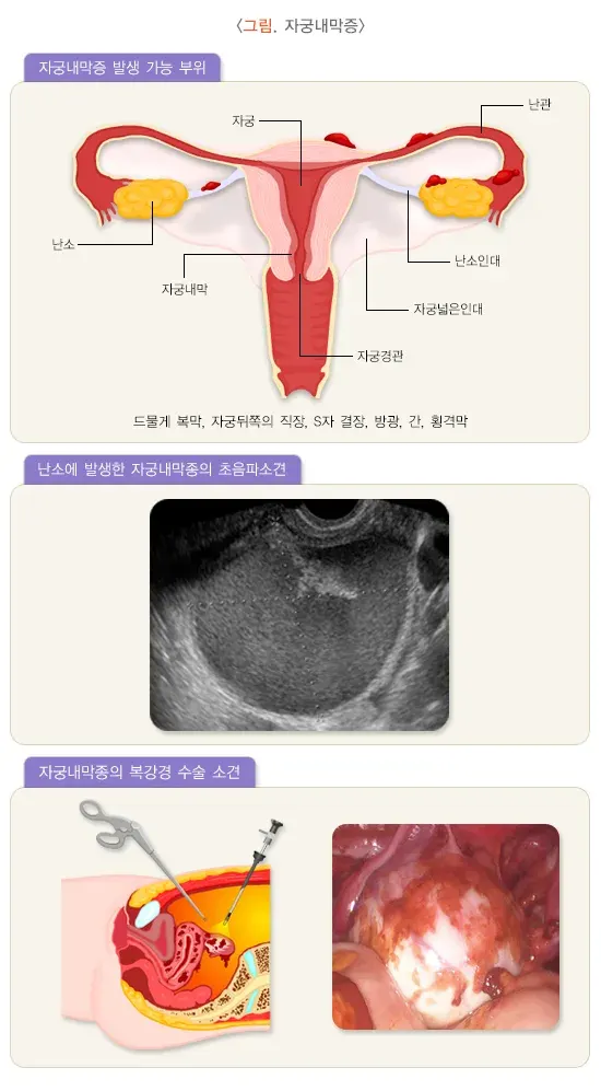 생리통 진단 및 검사 설명 이미지 3