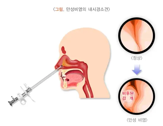 만성비염 진단 및 검사 설명 이미지 1