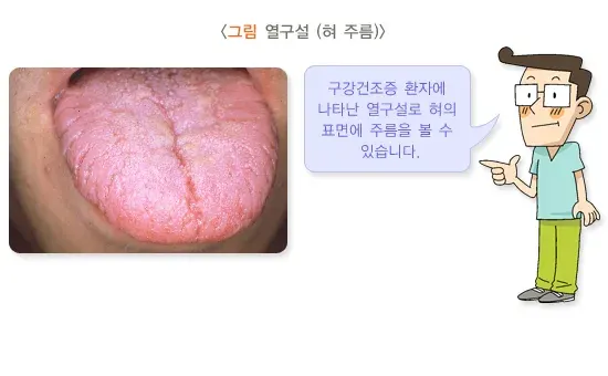 구강건조증 종류 설명 이미지 3