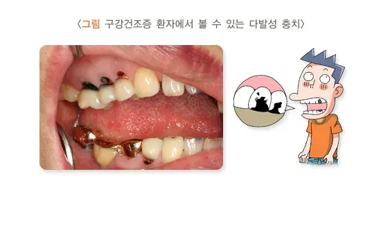 구강건조증 종류 설명 이미지 1