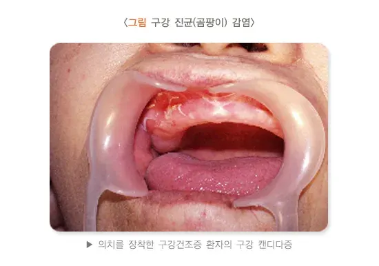 구강건조증 종류 설명 이미지 2