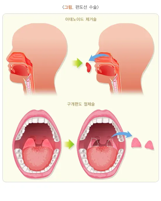 편도염 비약물 치료 설명 이미지 1
