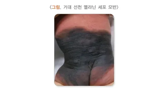 모반(점) 종류 설명 이미지 1
