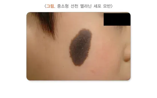 모반(점) 종류 설명 이미지 2
