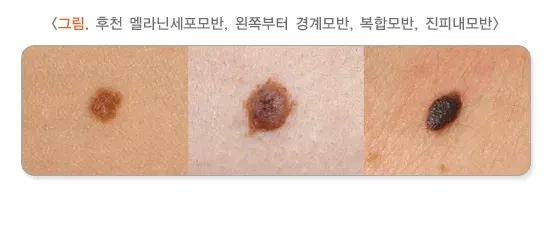 모반(점) 종류 설명 이미지 3