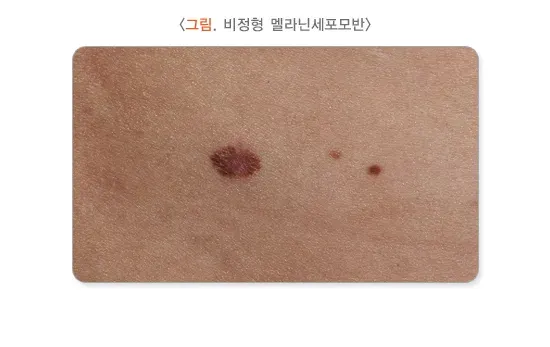 모반(점) 종류 설명 이미지 4