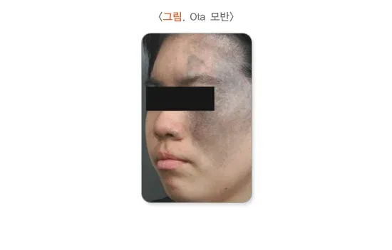 모반(점) 종류 설명 이미지 5