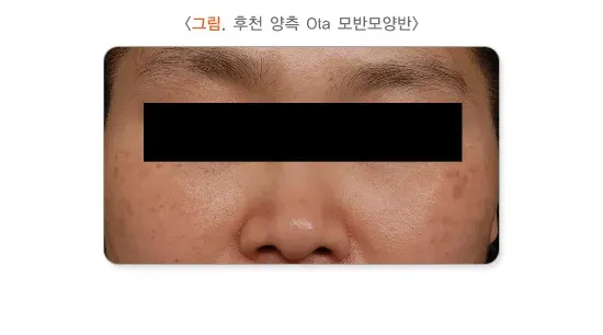 모반(점) 종류 설명 이미지 6