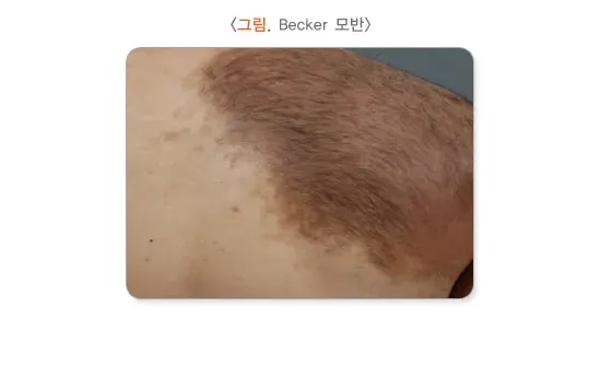모반(점) 종류 설명 이미지 7