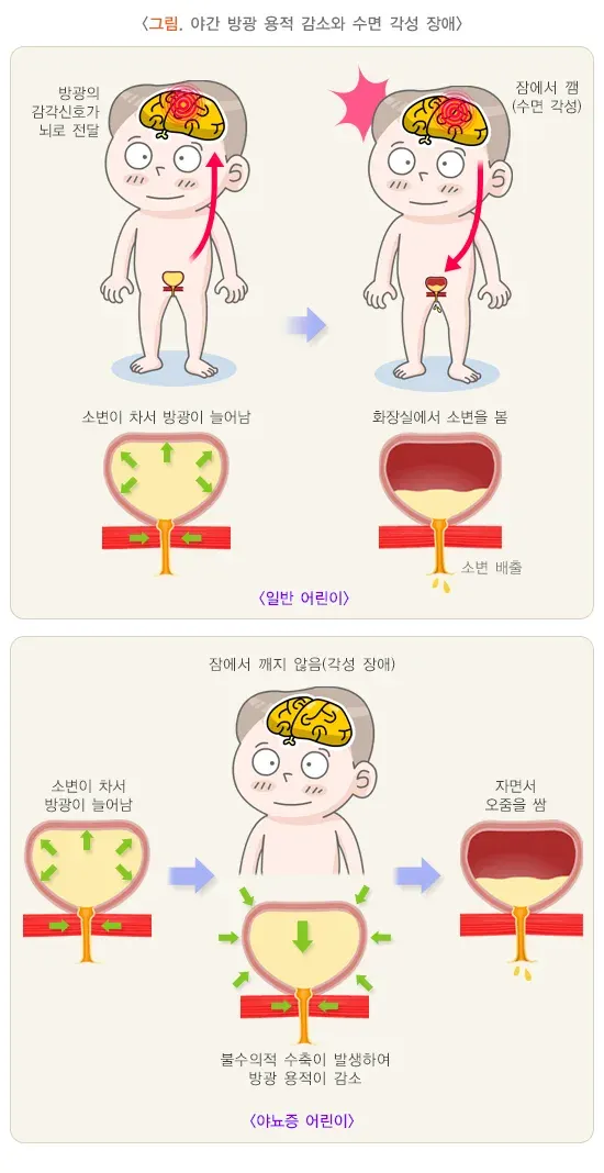 야뇨증(소아) 원인 설명 이미지 2