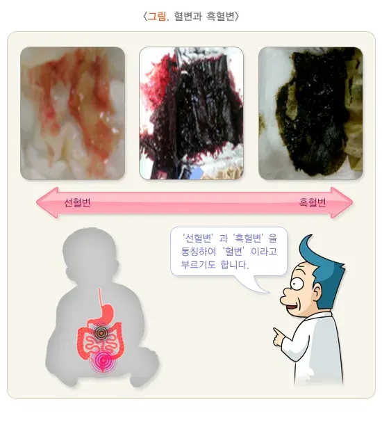 소아 청소년의 혈변 및 흑혈변 정의 설명 이미지 1