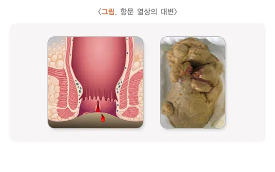 소아 청소년의 혈변 및 흑혈변 원인 설명 이미지 1