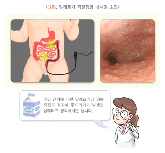 소아 청소년의 혈변 및 흑혈변 원인 설명 이미지 3