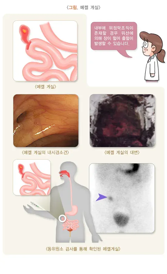 소아 청소년의 혈변 및 흑혈변 원인 설명 이미지 4