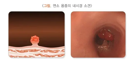 소아 청소년의 혈변 및 흑혈변 원인 설명 이미지 5