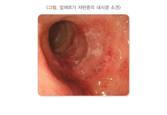소아 청소년의 혈변 및 흑혈변 원인 설명 이미지 6