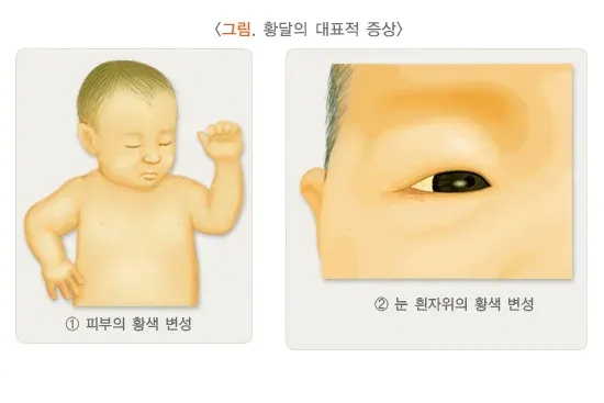 신생아 황달 정의 설명 이미지 2
